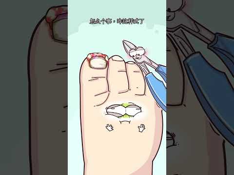 甲沟炎怎么越剪越严重？ #animation #沙雕剧情 #funny #搞笑 #動畫